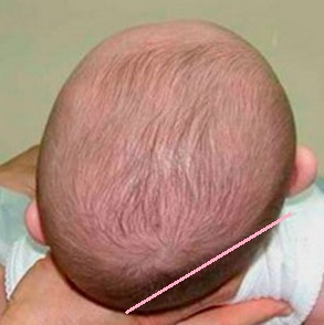 chiropractic and flat heads in babies